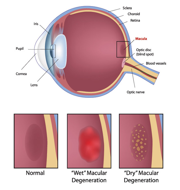 macular-degeneration