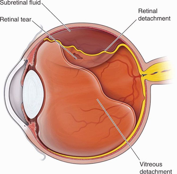 retinal detachment