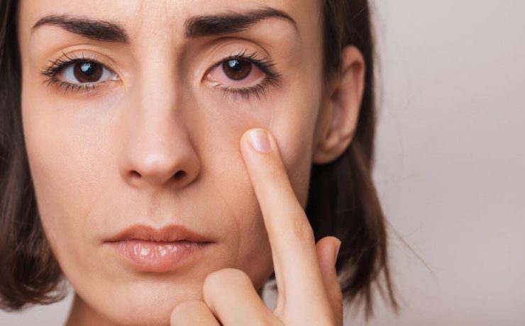 Spring Allergies and Your Eyes Tips for Reducing Irritation