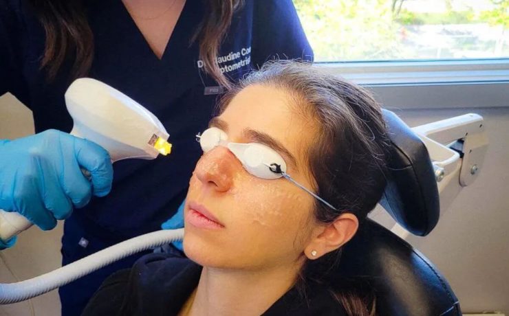 IPL Dry Eye Treatment Session