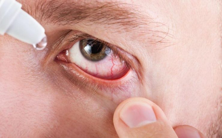 Cure Itchy Eyes from Allergies