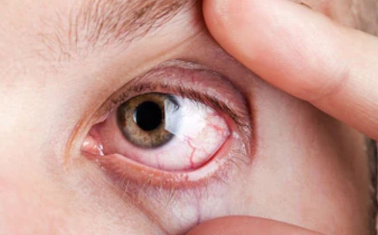 Dry Eye in Manchester