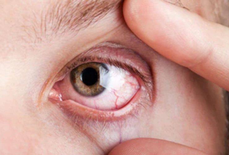 Dry Eye in Manchester