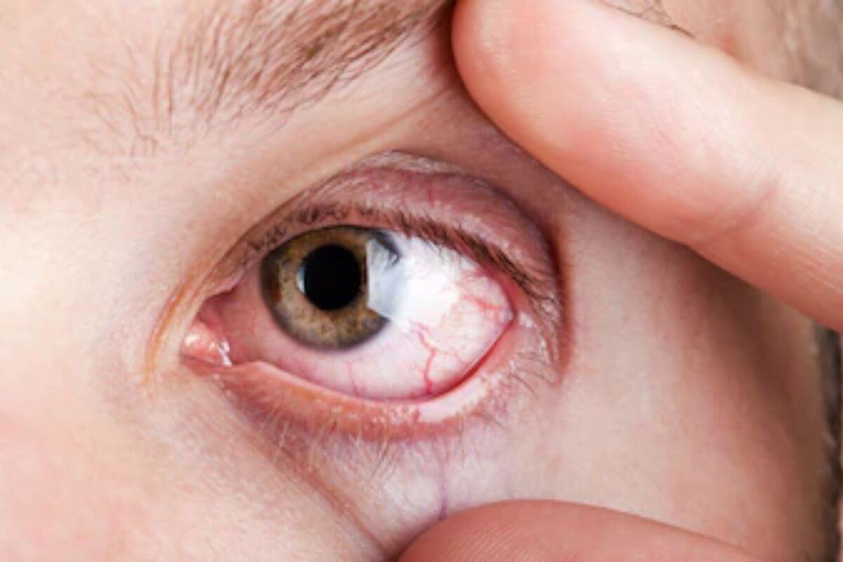 Dry Eye in Manchester