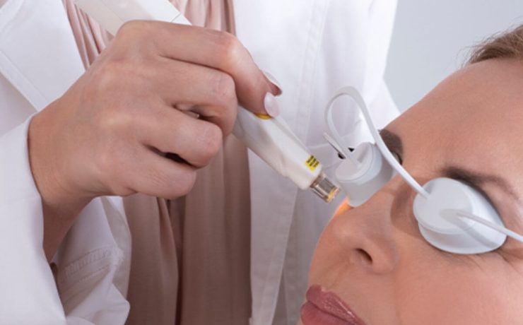 Dry Eyes Are More Than Just an Irritation How OptiLight IPL Can Help