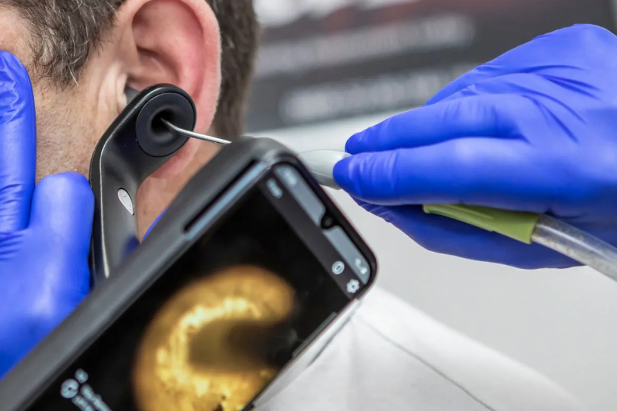 Microsuction Ear Wax Removal